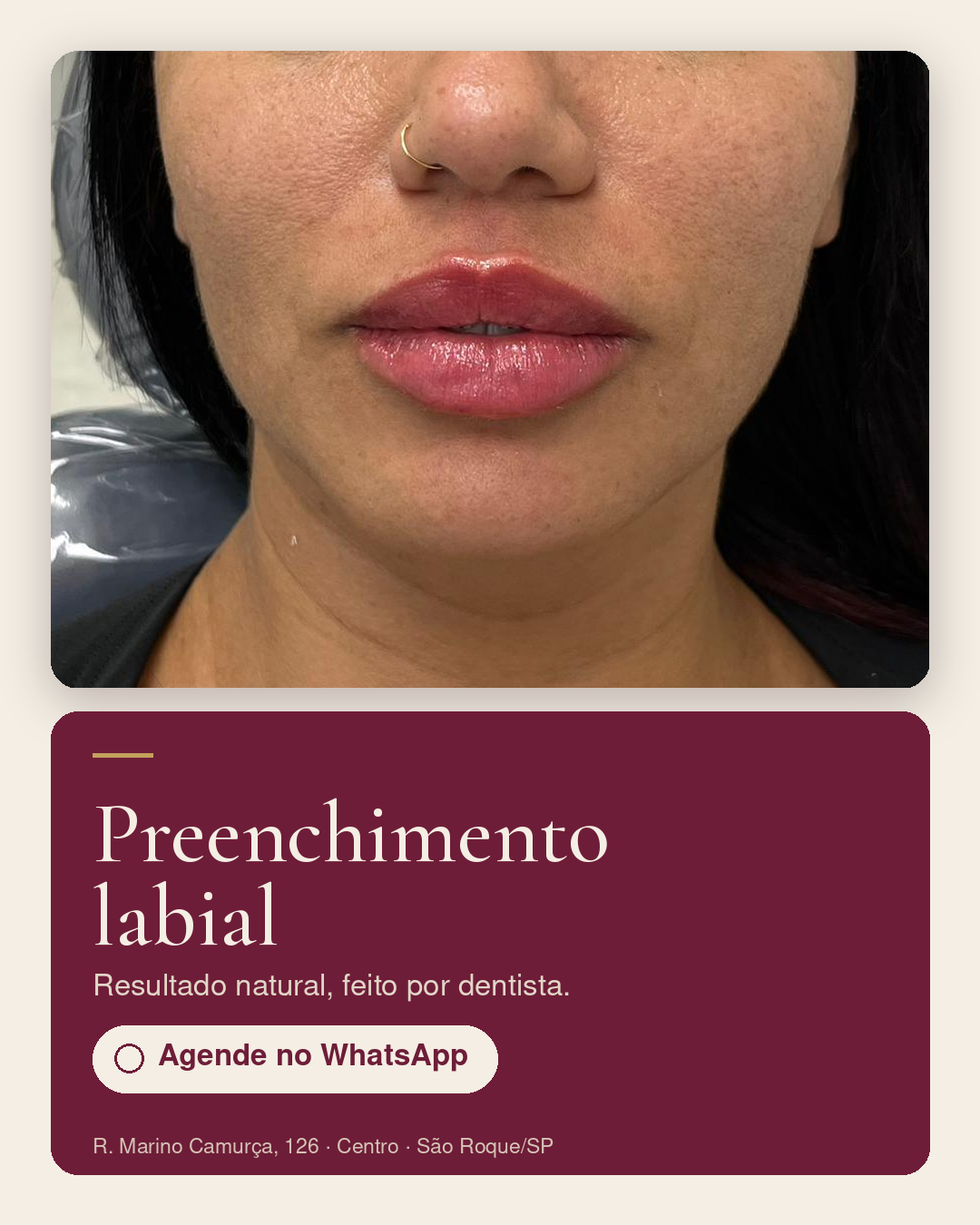 Preenchimento labial
